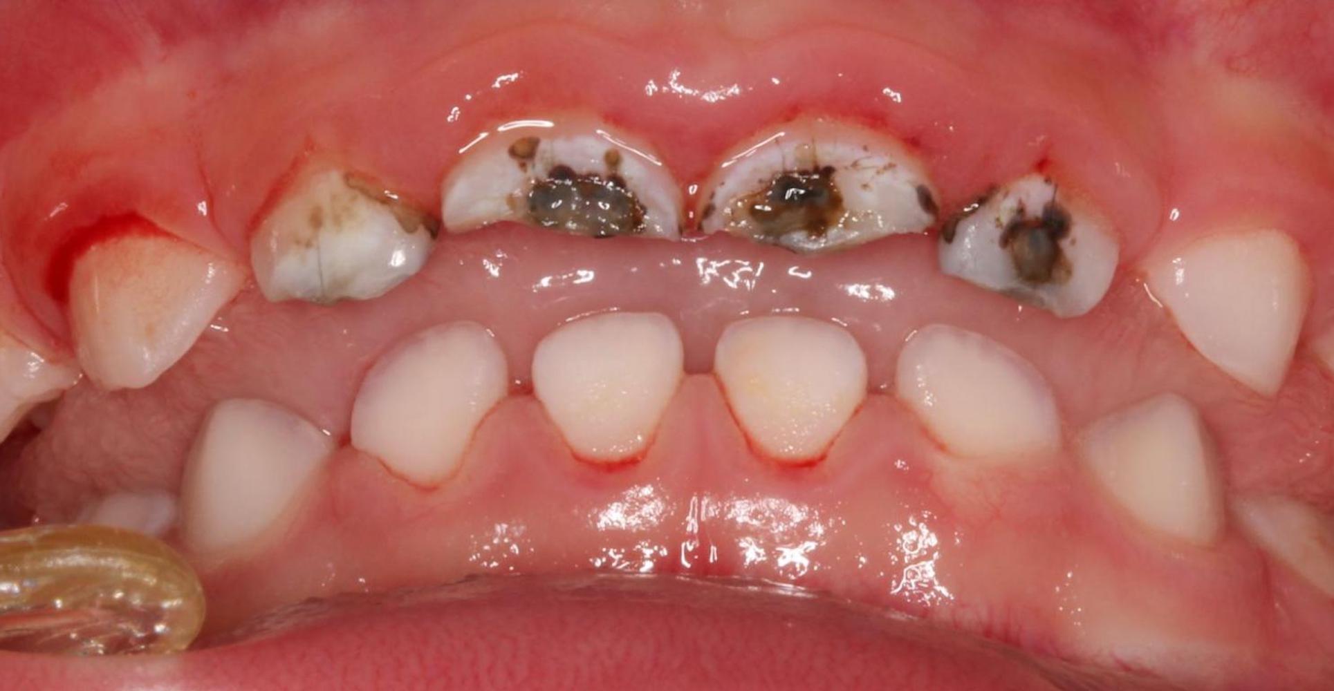 thumbnail image 2 of 24-Pack Resin Transparent Strip Crowns For Pediatric Anterior Teeth - Kids' Dental Deciduous Crowns 2 of 3