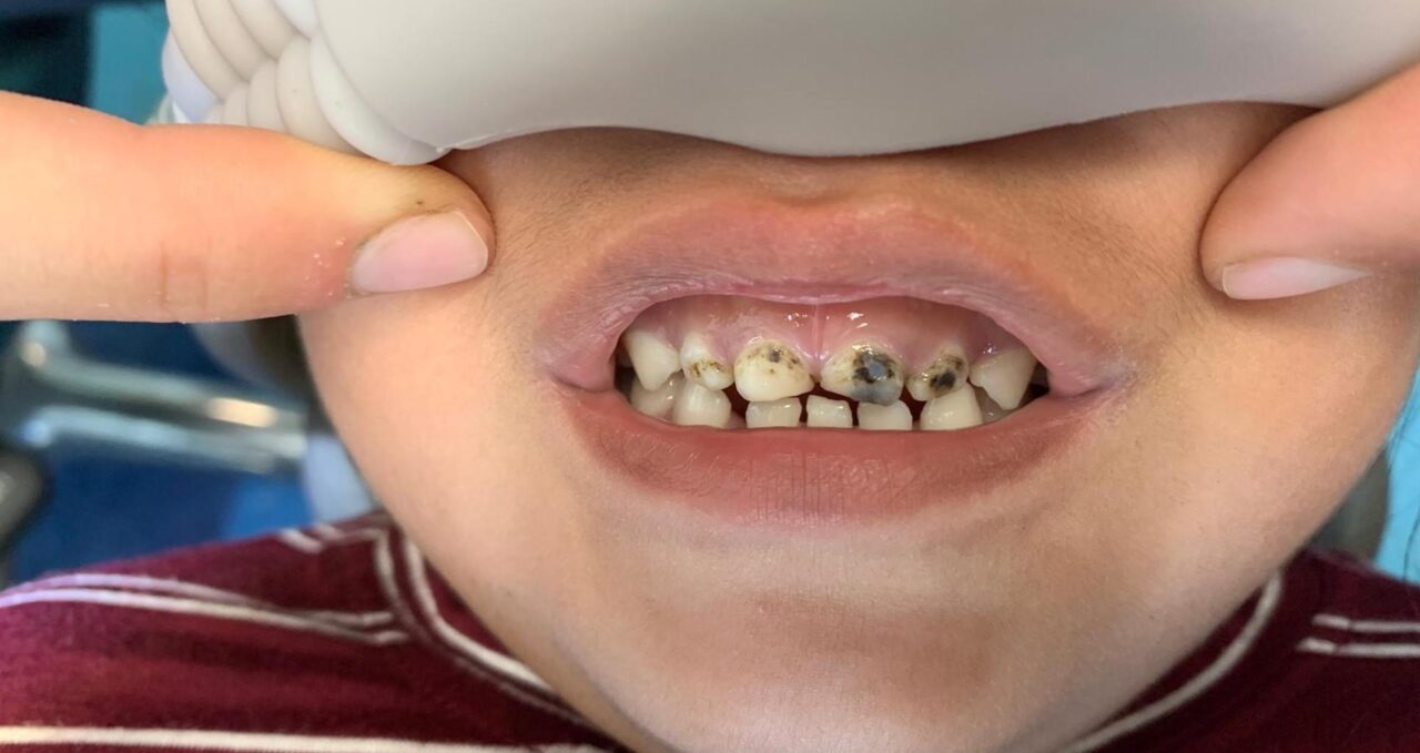 Santa Maria Pediatric Dental Crowns White Anterior Crowns