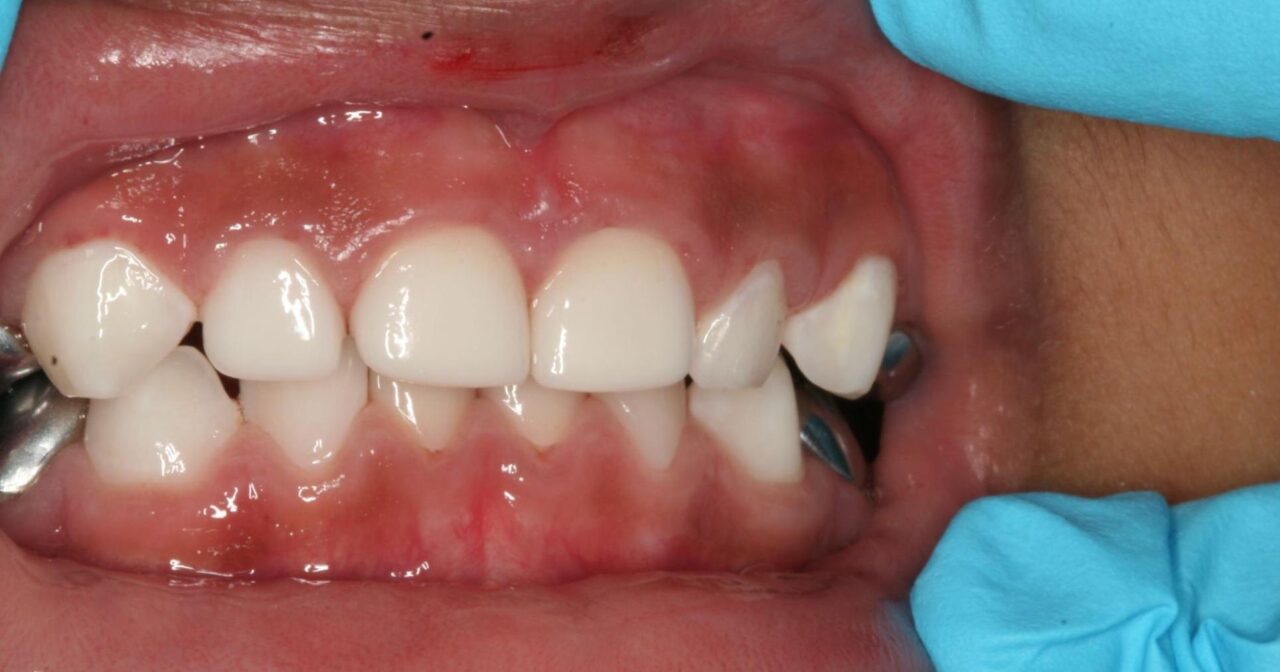 Santa Maria Pediatric Dental Crowns | White Anterior Crowns