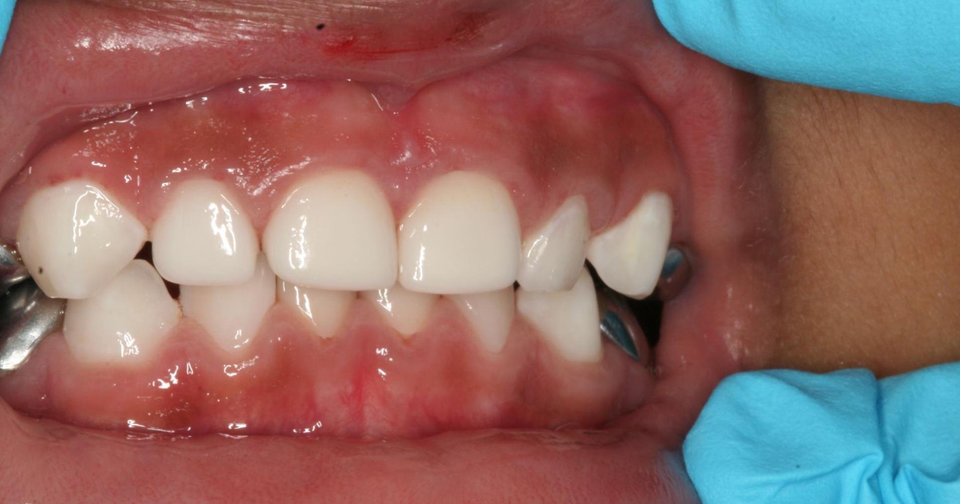 Santa Maria Pediatric Dental Crowns | White Anterior Crowns