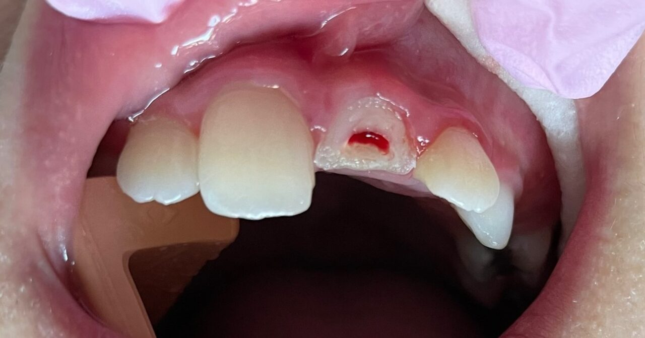 Santa Maria Pediatric Dental Crowns White Anterior Crowns