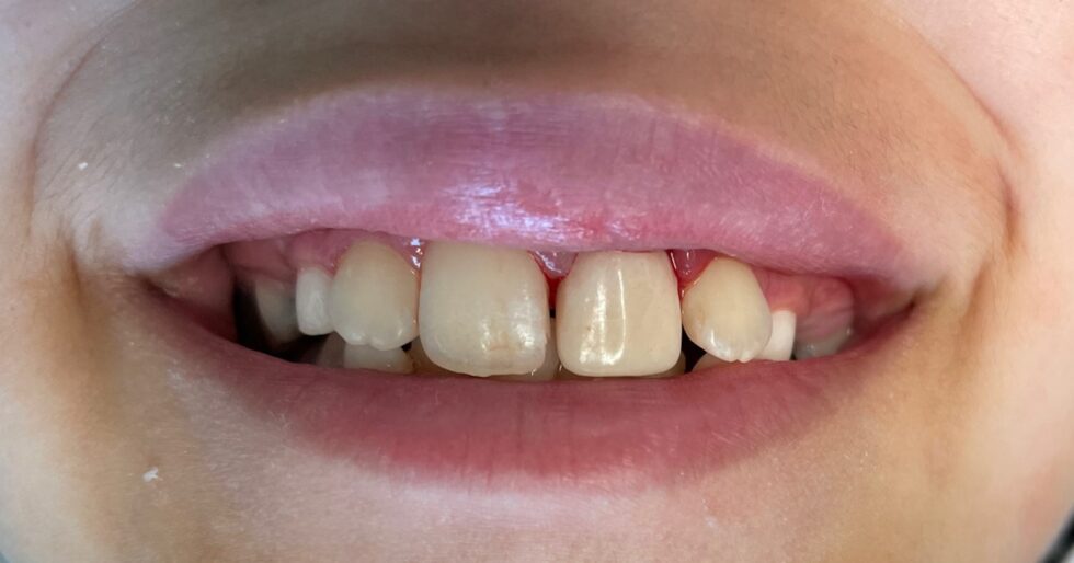 Santa Maria Pediatric Dental Crowns | White Anterior Crowns